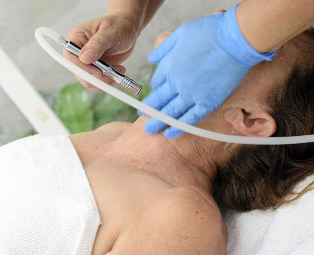 microneedling