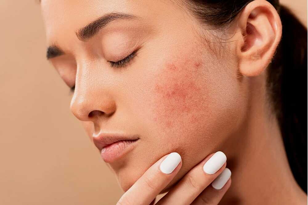 microneedling